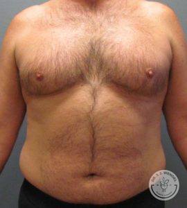 male patient before gynecomastia and liposuction