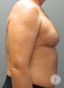 male patient before gynecomastia and liposuction