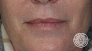 Before juvederm