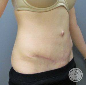 female torso before scar revision