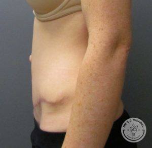 female torso before scar revision