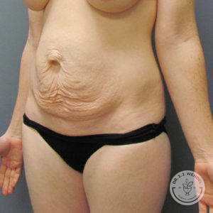 female torso before tummy tuck
