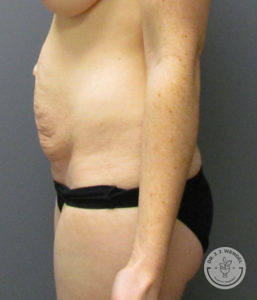 female torso before tummy tuck