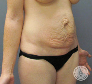 female torso before tummy tuck