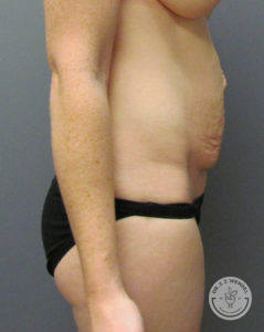 female torso before tummy tuck