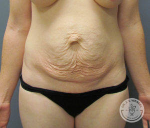 female torso before tummy tuck