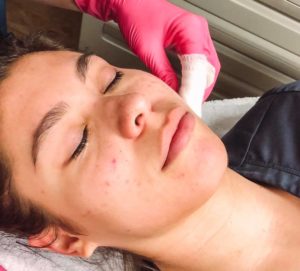 woman laying down with towel covering hair and chemical peel being applied to her face