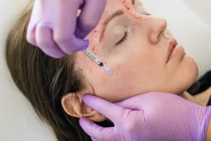 woman recieving a PRP facial