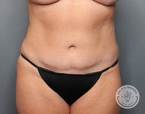 After tummy tuck front view