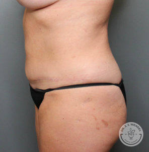 After a tummy tuck side view
