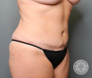 After tummy tuck side front view