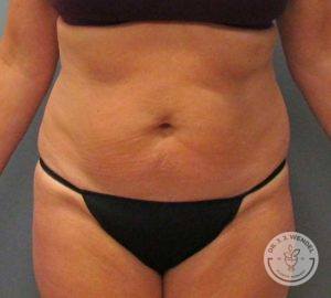 Before tummy tuck front view