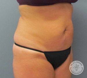 Before tummy tuck side front view