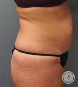 Before tummy tuck side view
