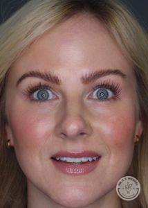close up of woman's face eyes wide after botox