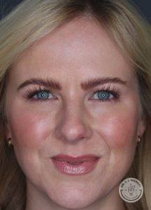 close up of woman's face after botox