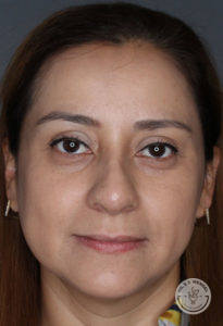 close up of woman's face after liquid rhinoplasty