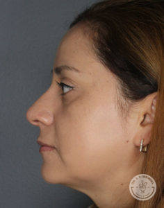 side view of woman's face after liquid rhinoplasty
