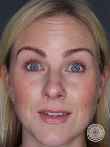 close up of woman's face eyes wide before botox