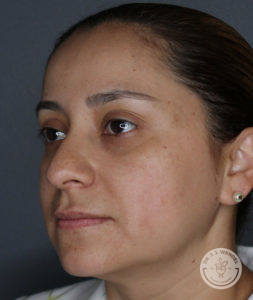 close up of woman's face before liquid rhinoplasty