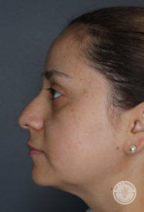 side view of woman's face before liquid rhinoplasty