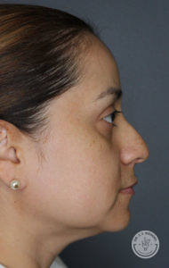 side view of woman's face before liquid rhinoplasty