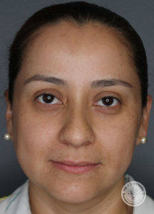 close up photo of woman's face before liquid rhinoplasty