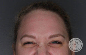 woman's forehead frowning after botox