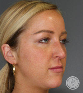 woman's left side profile after cheek filler