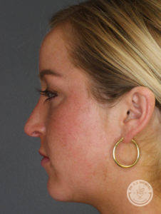 woman's right side profile after cheek filler