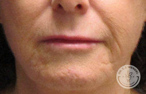 woman's lips after lip implants