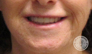 woman's lips smiling after lip implants