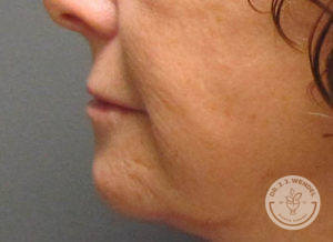 side profile of woman's lips after lip implants