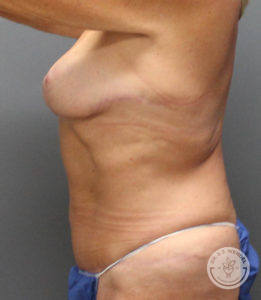 woman's torso right side profile after tummy tuck and breast implant removal