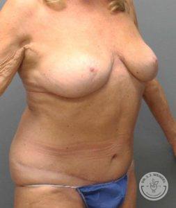 woman's torso angled left after tummy tuck and breast implant removal