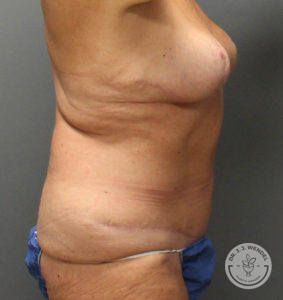 woman's torso left side profile after tummy tuck and breast implant removal
