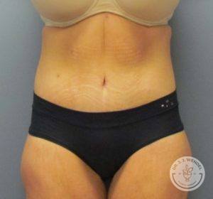 woman's torso after tummy tuck