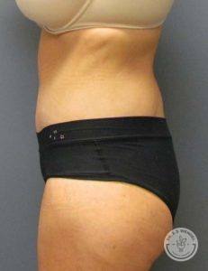 woman's torso right side view after tummy tuck