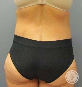 woman's backside after tummy tuck