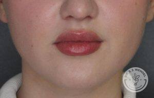 woman's lips close up after juvederm vollure injections
