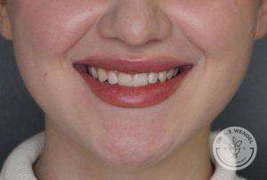 woman's lips smiling close up after juvederm vollure injections