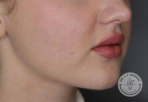 woman's lips side profile after juvederm vollure injections