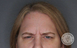woman's forehead frowning before botox