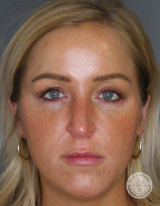 woman's face before cheek filler