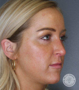 woman's left side profile before cheek filler