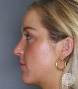 woman's right side profile before cheek filler