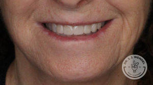 woman's lips smiling before lip implants