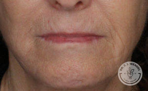 woman's lips before lip implants