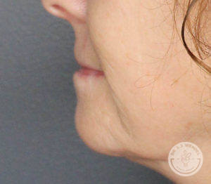 side profile of woman's lips before lip implants