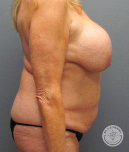 woman's torso left side profile before tummy tuck and breast implant removal